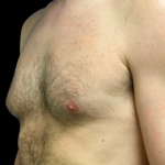 Gynecomastia Before & After Patient #5347