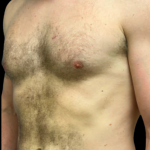 Gynecomastia Before & After Patient #5347