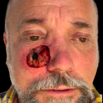 MOHS Before & After Patient #5348