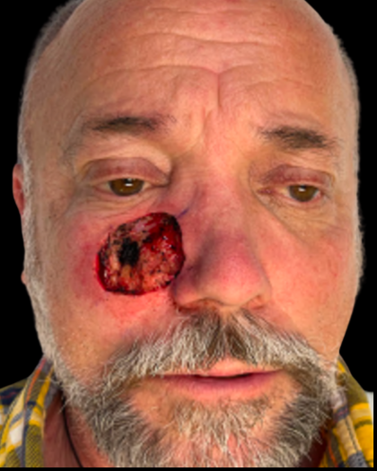 MOHS Before & After Patient #5348