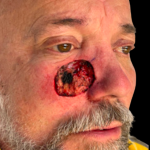 MOHS Before & After Patient #5348