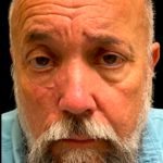 MOHS Before & After Patient #5348