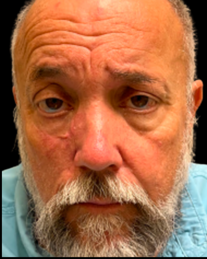 MOHS Before & After Patient #5348