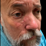 MOHS Before & After Patient #5348