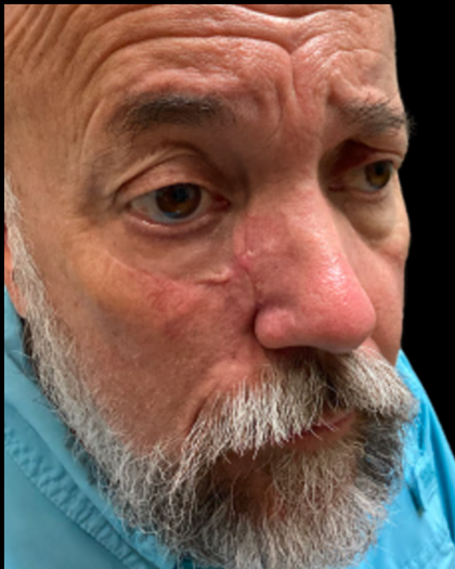 MOHS Before & After Patient #5348