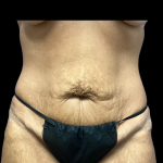 Tummy Tuck Before & After Patient #5352