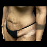 Tummy Tuck Before & After Patient #5352
