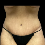 Tummy Tuck Before & After Patient #5352