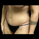 Tummy Tuck Before & After Patient #5352