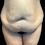 Tummy Tuck Before & After Patient #5353