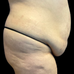 Tummy Tuck Before & After Patient #5353