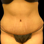 Tummy Tuck Before & After Patient #5353