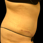 Tummy Tuck Before & After Patient #5353
