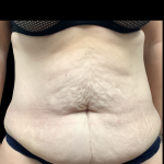 Tummy Tuck Before & After Patient #5354
