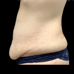 Tummy Tuck Before & After Patient #5354