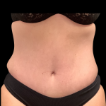 Tummy Tuck Before & After Patient #5354