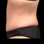 Tummy Tuck Before & After Patient #5354