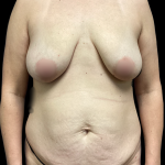 Mommy Makeover Before & After Patient #5349