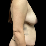 Mommy Makeover Before & After Patient #5349