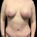 Mommy Makeover Before & After Patient #5349
