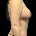 Mommy Makeover Before & After Patient #5349