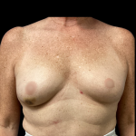 Breast Reconstruction Before & After Patient #5351