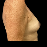 Breast Reconstruction Before & After Patient #5351