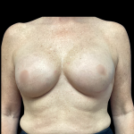 Breast Reconstruction Before & After Patient #5351