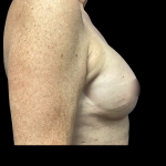 Breast Reconstruction Before & After Patient #5351