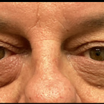 Blepharoplasty Before & After Patient #5425