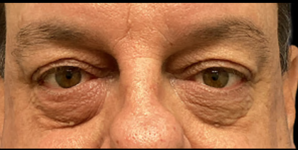 Blepharoplasty Before & After Patient #5425