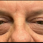 Blepharoplasty Before & After Patient #5425