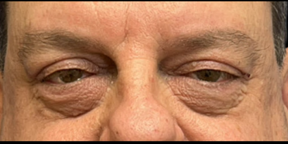 Blepharoplasty Before & After Patient #5425