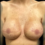Breast Reconstruction Before & After Patient #5344