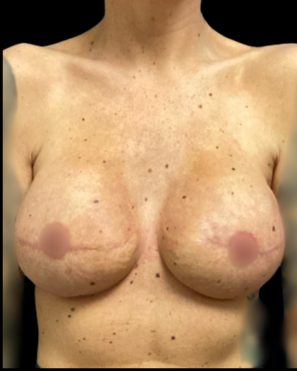 Breast Reconstruction Before & After Patient #5344