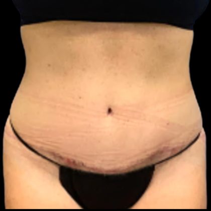 Tummy Tuck Before & After Patient #5433