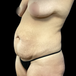 Mommy Makeover Before & After Patient #5295