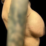 Breast Reconstruction Before & After Patient #5344