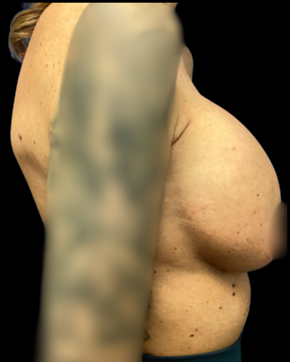 Breast Reconstruction Before & After Patient #5344