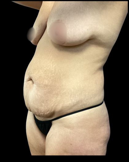Mommy Makeover Before & After Patient #5295
