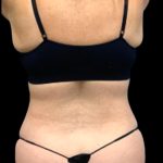 Tummy Tuck Before & After Patient #5433