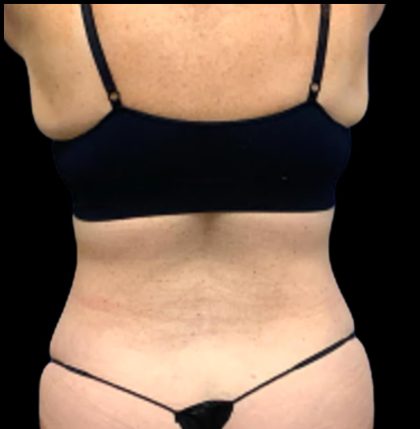 Tummy Tuck Before & After Patient #5433
