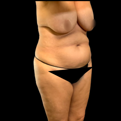Tummy Tuck Before & After Patient #5429
