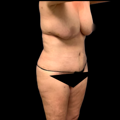 Tummy Tuck Before & After Patient #5429