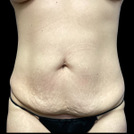 Tummy Tuck Before & After Patient #5460