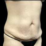 Tummy Tuck Before & After Patient #5460