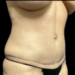 Tummy Tuck Before & After Patient #5460