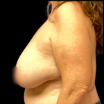 Breast Reduction Before & After Patient #5430