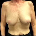 Breast Reduction Before & After Patient #5430