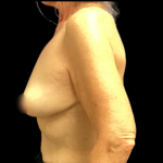 Breast Reduction Before & After Patient #5430